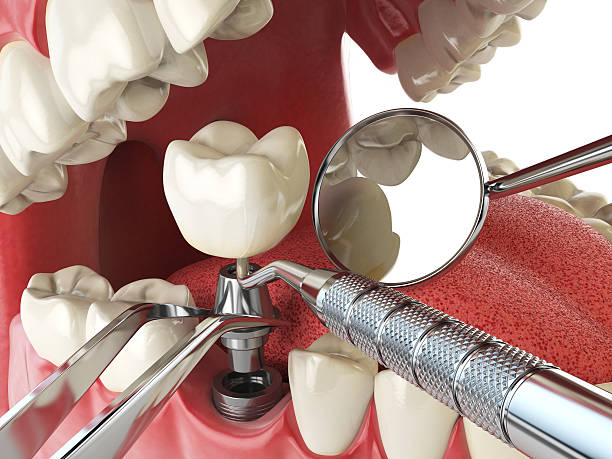 Best Knocked-Out Tooth Emergency  in Onsted, MI